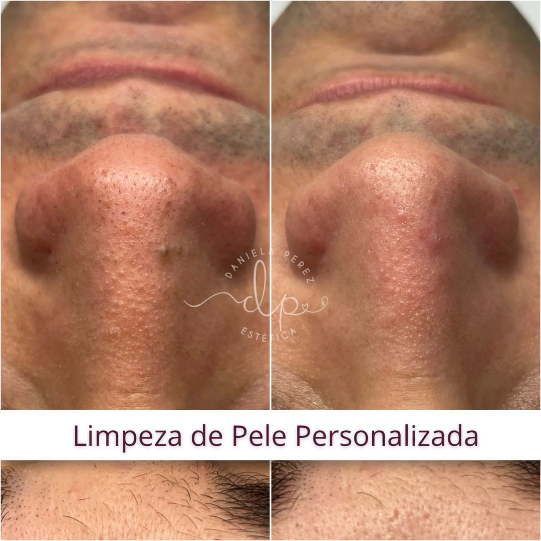 Resultado de limpeza de pele profissional em Joinville